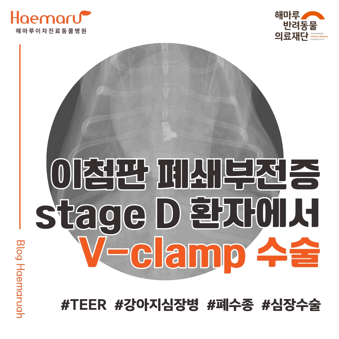 강아지 V-clamp 장착술(TEER) - 폐수종이 지속된 강아지 이첨판 폐쇄 부전증 stage D 환자에서 V-clamp 수술 썸네일